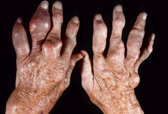 Hands disfigured by gout