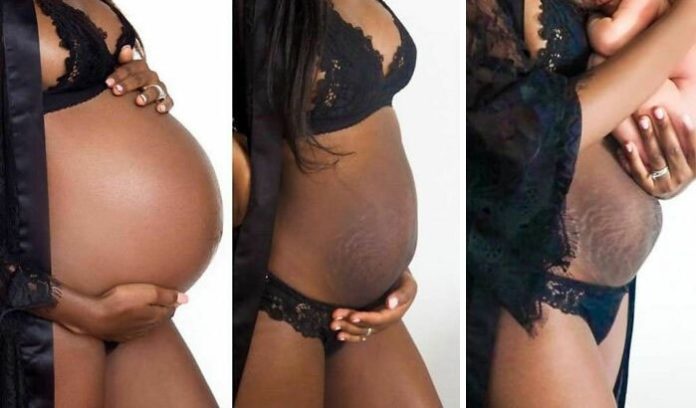 postpartum woman belly